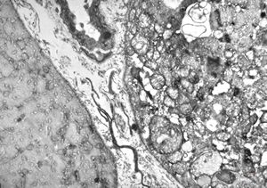 F,25y. | myopathy - atrophic and regenerating muscle cells